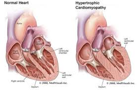 Hypertrophic Cardiomyopathy Which Is The Left Ventricle Is Thicker Than The The Normal Hearts Hypertrophic Cardiomyopathy Critical Care Nursing Echocardiogram
