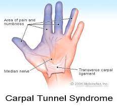 Carpal Tunnel Syndrome Symptoms, Treatment, Causes & Tests