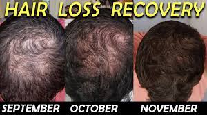 Like finasteride (the active based on these results, dutasteride should be significantly more effective in the treatment of. 3 Month Hair Loss Reversal With Dutasteride Minoxidil And Saw Palmetto Youtube