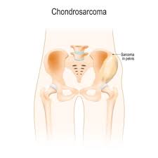 Image result for Chondrosarcoma