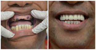 A dental cleaning can cost anywhere between $75 to $400 (with no insurance), depending on the type of cleaning required and the patient's age. Full Mouth Reconstruction Nyc Information Pricing