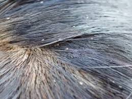The answer is both yes and no. Doctor Nit Picks Myths About Lice With Real Solutions To Wipe Out New York City Ny Patch