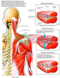 Pin On Managing Back Pain