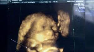 Janin yang terlihat tersebut masih berupa titik janin saat usia kehamilan masih 5 minggu. Penampakan Wajah Misterius Muncul Dalam Hasil Usg Bayi Ini Global Liputan6 Com