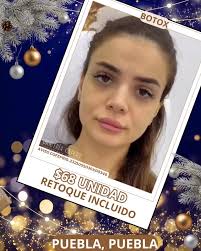 🎁 Atenúa líneas de expresión, ❄️$68 unidad. + retoque día 10, 🎄  Valoración sin costo , 👨‍⚕️ Dr. Marco Bazán Yitani