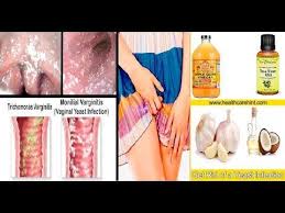 If this condition recurs frequently, you need to learn how to prevent it as opposed to continually treating it when it. 4 Home Remedies To Get Rid Of A Yeast Infection Fast In 1 Day Yeast Infection Home Remedies Remedies