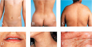 Image result for Diffuse Hyperpigmentation