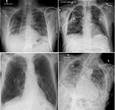 A pneumothorax can be caused by: Spontaneous Pneumothorax An Emerging Complication Of Covid 19 Pneumonia Heart Lung The Journal Of Cardiopulmonary And Acute Care