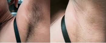 Permanently remove hair in the comfort of your home! Laser Hair Removal Philadelphia Permanent Hair Removal Pa