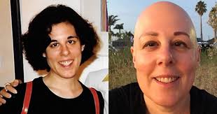 Alopecia personal story: What it's really like.