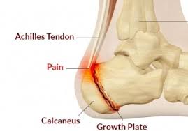 Image result for Calcaneal Apophysitis