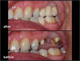 We did not find results for: Dental Bridge Dentistry By Dr Sferlazza Mississauga On Dentist
