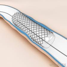 What Are The Most Common Stent Side Effects With Pictures
