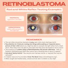 Image result for Red Reflex