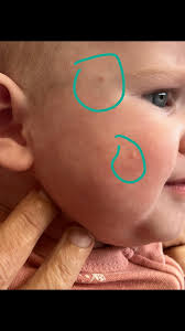 Does anyone know if it is possible to get psoriasis