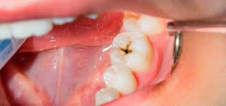 Mal Sabor De Boca Que Solucion Tiene Ferrus Bratos