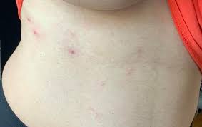 Simptomele aparitiei acesti boli sunt similare cu cele ale aparitiei varicelei. Care Este Conduita Si Tratamentul In Zona Zoster Meda Talos