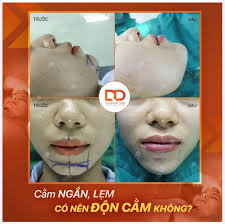 CẰM NGẮN, CẰM LẸM CÓ NÊN ĐỘN CẰM KHÔNG