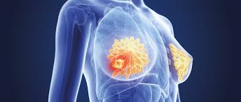 Menopause occurs when a woman's ovaries stop releasing eggs. Breast Cancer World Cancer Research Fund International