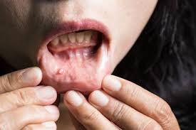 Hpv is a common virus that can lead to certain types of cancer later in life. Sexo Oral E A Principal Forma De Transmissao Do Hpv Diz Instituto Do Cancer Reporter Beto Ribeiro