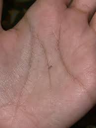 Image result for Fly Bite