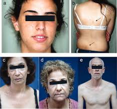 A novel XPD mutation in a compound heterozygote; the mutation in the second  allele is present in three homozygous patients with mild sun sensitivity