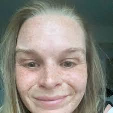 What is this new dent in my cheek and how can I fix it? (Photos)