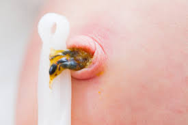 Die nabelschnur, anatomisch funiculus umbilicalis genannt, verbindet den embryo beziehungsweise fetus mit der plazenta im mutterleib von plazentatieren, wozu außer kloakentieren und beuteltieren die meisten heutigen säugetierarten zählen wie auch der mensch. Nabelpflege Hallohebamme