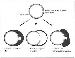 Endovascular Stent Graft Repair For Penetrating Atherosclerotic Ulcer In The Infrarenal Abdominal Aorta Journal Of Vascular Surgery