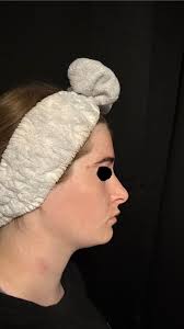 Lip flip &/or filler recommendations?