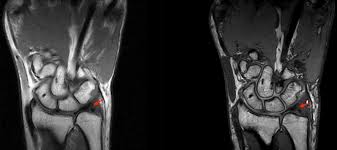 So to the guys who had the same injury how long tfcc injuries typically have a lower than normal full recovery rate so it is important you only perform. Imaging Of Tfcc Injury Of The Wrist Coachingultrasound