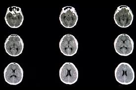 Sintomas de aneurisma cerebral wikipedia. Aneurisma O Que E Seus Sintomas E Tratamentos Pedro Albino