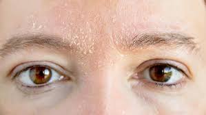 Tak hanya itu, rasa tidak nyaman, perih, dan sakit juga terkadang timbul ketika kita memakai kaki yang kulitnya kering untuk berjalan. Punya Kulit Kering Dan Bersisik Atasi Dengan Cara Berikut Ini