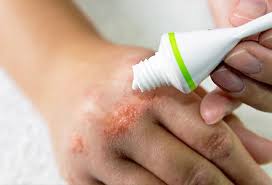 Eczema Treatment Cream Types Dyshidrotic Baby Causes Symptoms
