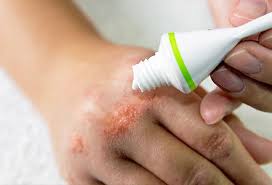 How to manage eczema on the face. Eczema Treatment Cream Types Dyshidrotic Baby Causes Symptoms