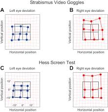 Strabismus Measurements With Novel Video Goggles Sciencedirect