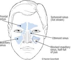 Sinusitis Harvard Health Sinusitis Sinus Pressure Symptoms Of Sinusitis