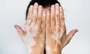 Image result for robert zaruba vitiligo