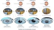 Chirurgie réfractive : opérations laser des yeux en France