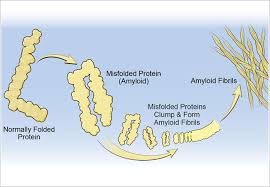 Antibody Treatment Holds Promise For Patients With Relapsed Or Refractory Light Chain Amyloidosis Consult Qd