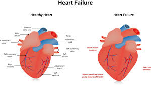 heart failure familydoctor org