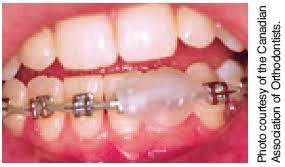 Apr 27, 2021 · applying the wax 1. Handling Appliance Complications