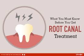 Maybe you would like to learn more about one of these? What You Must Know Before You Get Root Canal Treatment By Dr Priyanka Puri Lybrate