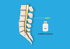 Image result for CSF Culture