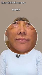 💃She makes it look wayyy too easy.☕️She’s even been out to Starbucks!  Nicci’s Omakase Facelift®️ included a deep plane extended facelift, deep  necklift, browlift, asymmetric lip lift with corner ...