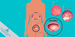 Image result for Interstitial Cystitis