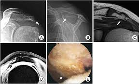 Mejores tableros de camila bigliani. Relationship Of The Shape Of Subacromial Spur And Rotator Cuff Partial Thickness Tear