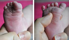 Image result for Babinski Reflex