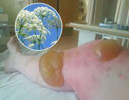 A birds can be responsible for a wide range of damage, some serious, some just annoying. Hogweed Warning Father Suffers Horrific Leg Injuries After Contact With Plant Uk News Express Co Uk
