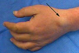 Ganglion cysts form near the joints in the wrists, fingers, or feet, and may be painful due to pressure on the surrounding nerves. Surgical Photos Of Ganglion Cysts
